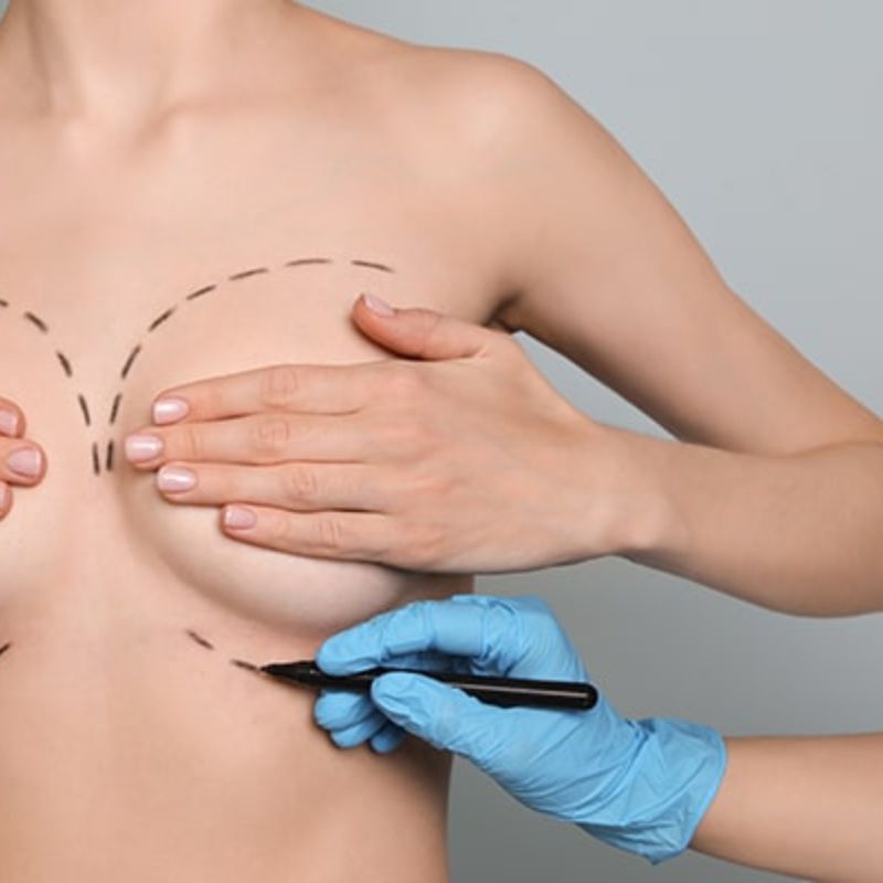 breast-reconstruction-hilton-head-img1 breast-reconstruction-hilton-head-img1