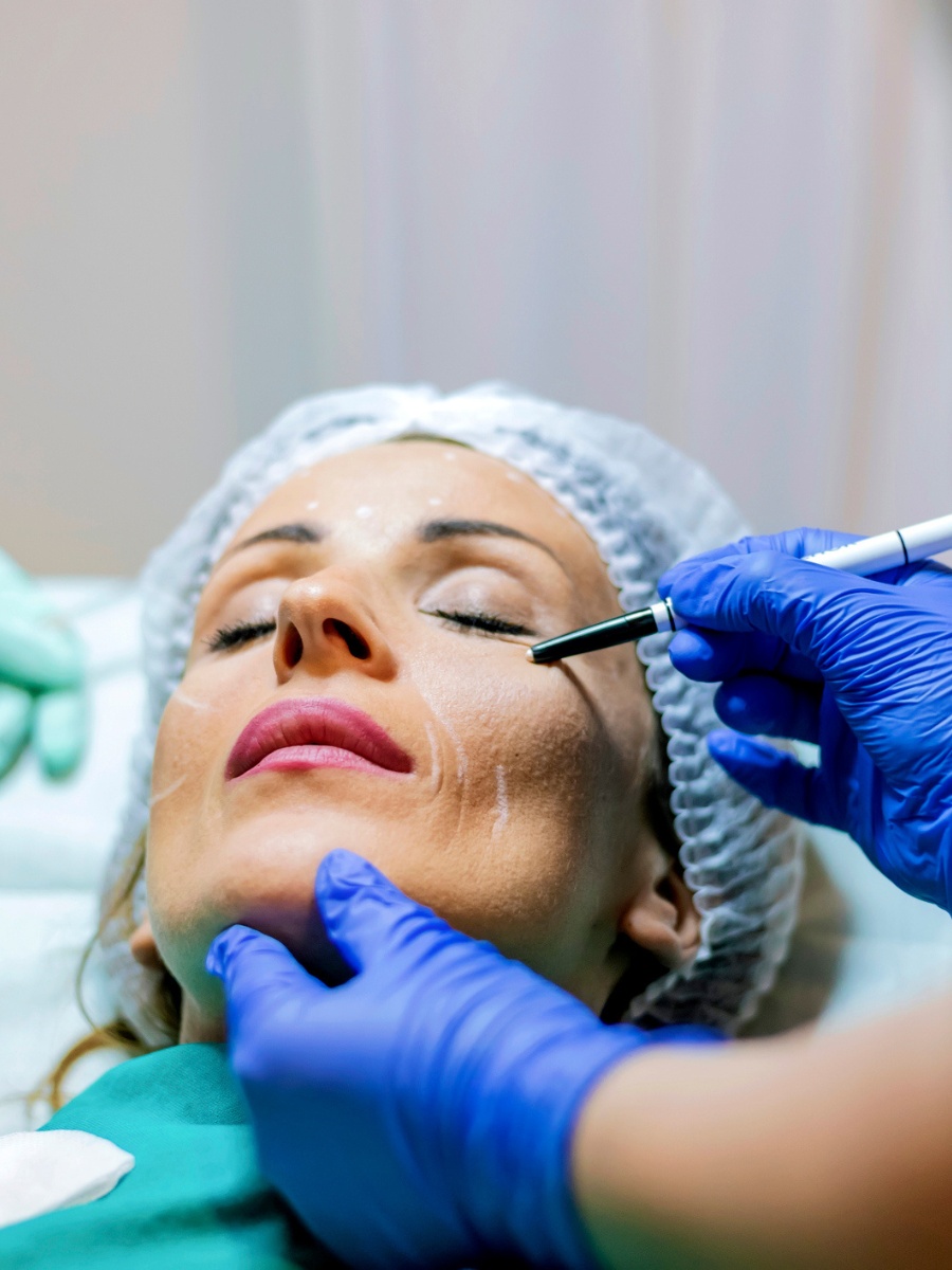 face-lift-pre-op-hilton-head1