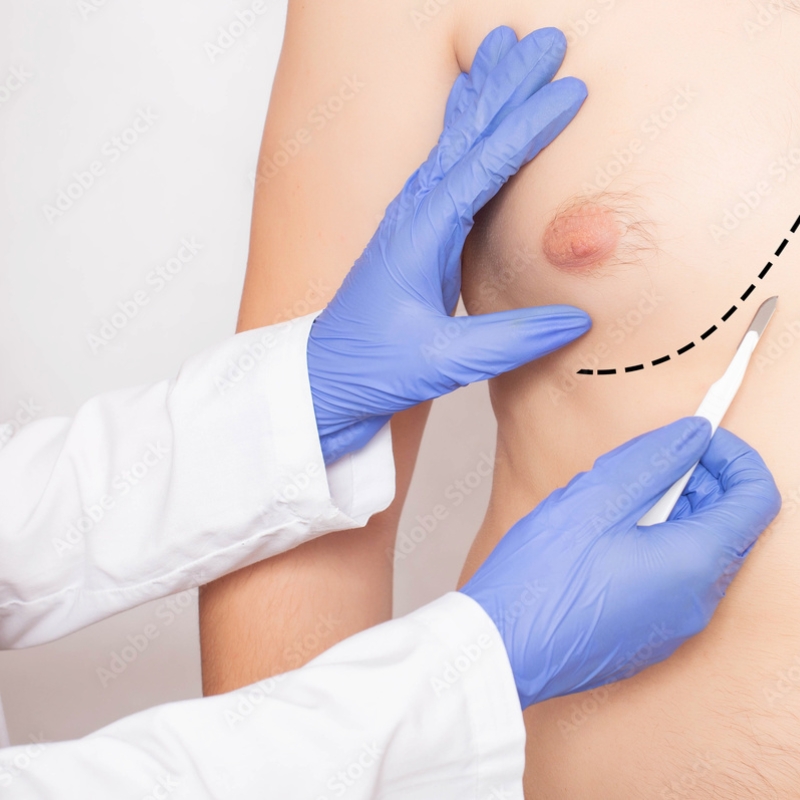 male-breast-reduction-hilton-head-img1 male-breast-reduction-hilton-head-img1