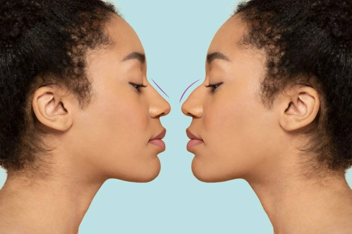 nose+bump-1920w nose+bump-1920w