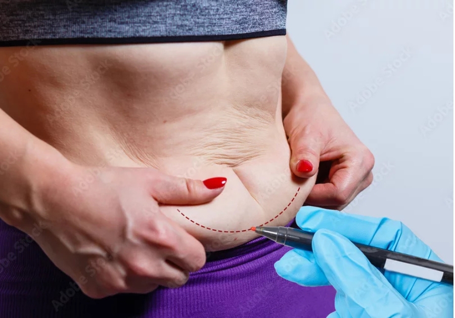 tummy-tuck-hiltonhead-island-sc-2-placeholder tummy-tuck-hiltonhead-island-sc-2-placeholder
